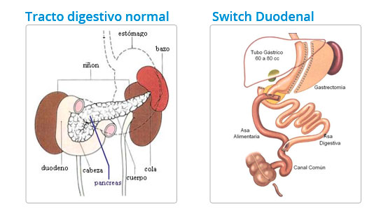 Switch Duodenal - Cirugía metabólica para curar la Diabetes Mellitus.