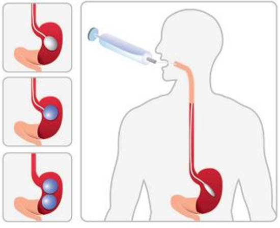 Ventajas y desventajas del balón intragástrico