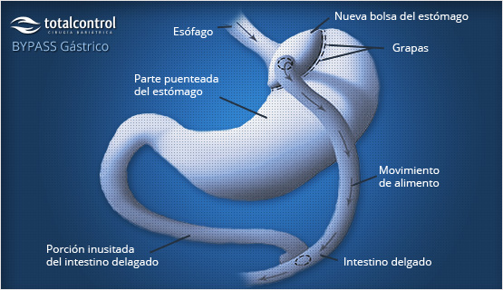 Bypass gástrico esquema