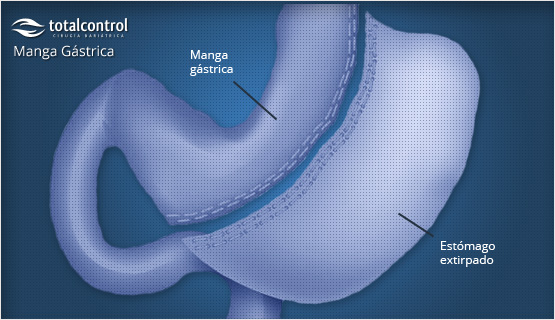 Manga gástrica esquema